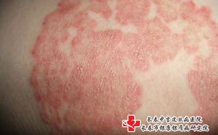 湿疹怎样护理,湿疹皮肤怎样护理