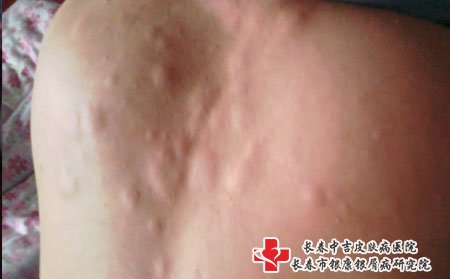 皮肤过敏