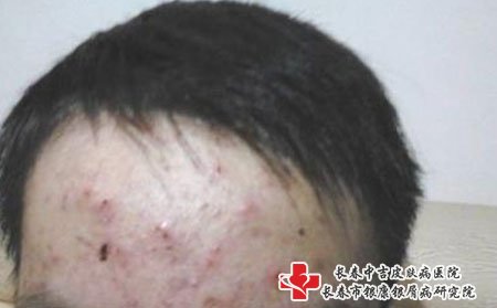痤疮