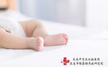 湿疹