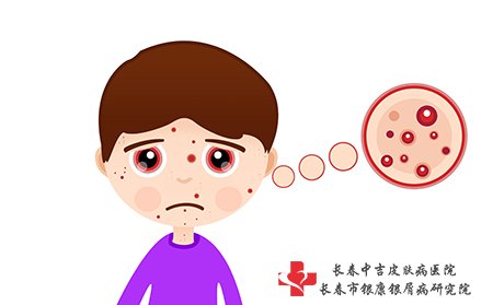 湿疹