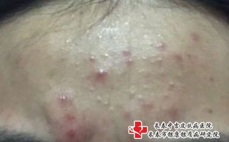 痤疮