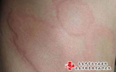 荨麻疹