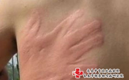 荨麻疹