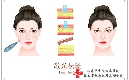 雀斑