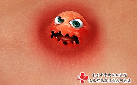 痤疮