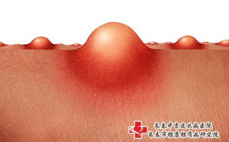 痤疮