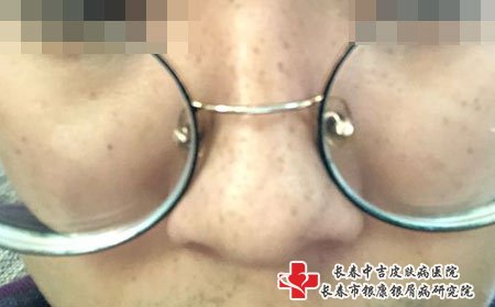 雀斑