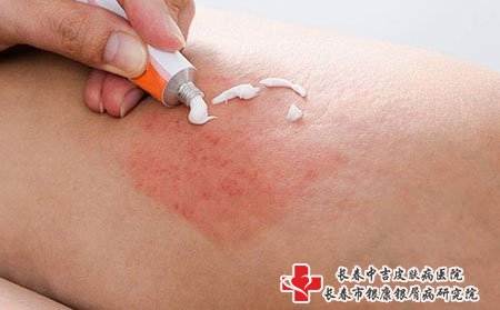长春湿疹专科医院：湿疹引起的原因是什么