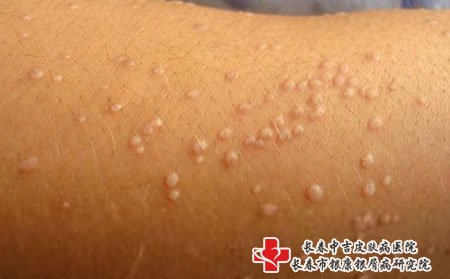预防扁平疣方法,怎样预防扁平疣