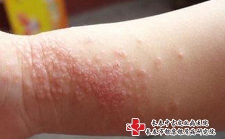 皮肤瘙痒怎么办,怎样缓解皮肤瘙痒