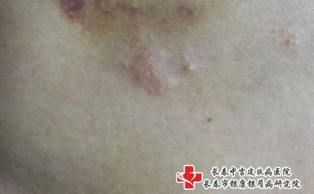 带状疱疹