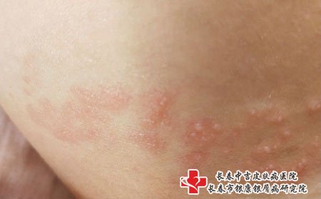 带状疱疹