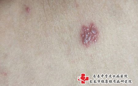 带状疱疹
