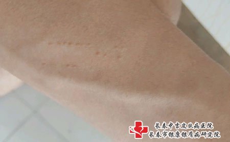 扁平疣