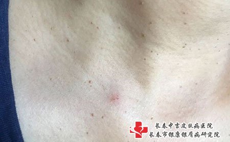 扁平疣
