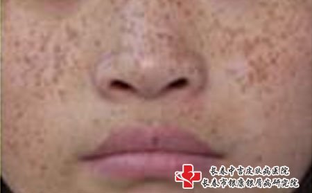 雀斑和黄褐斑,雀斑有什么症状