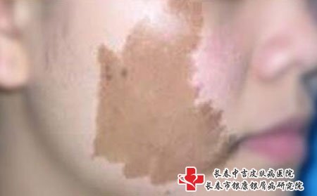 雀斑和黄褐斑,雀斑有什么症状