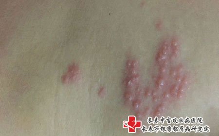 带状疱疹