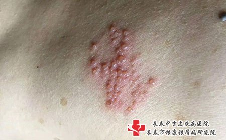 带状疱疹