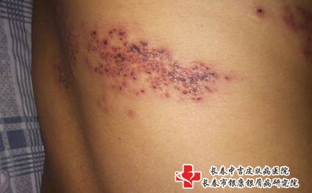 带状疱疹