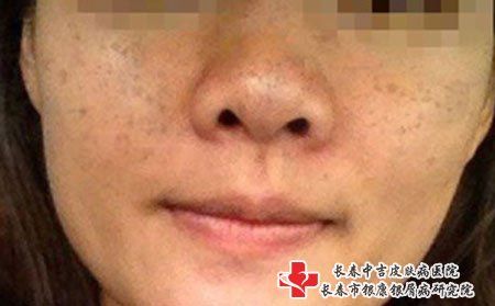 雀斑