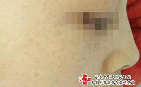 雀斑