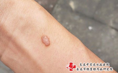 扁平疣