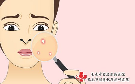 面部痤疮怎么办,脸上有痤疮怎么办