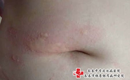 荨麻疹