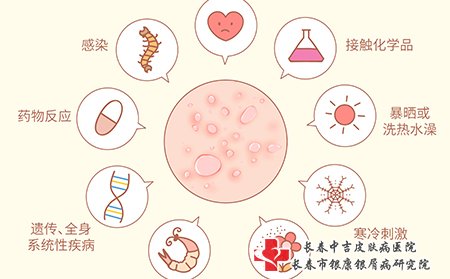 荨麻疹