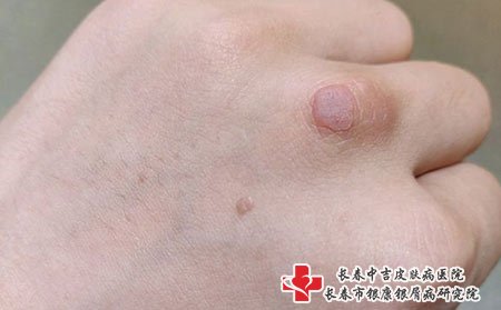 扁平疣