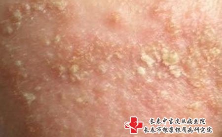皮肤瘙痒