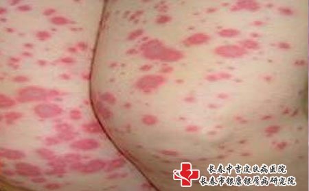 荨麻疹