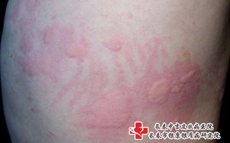 荨麻疹