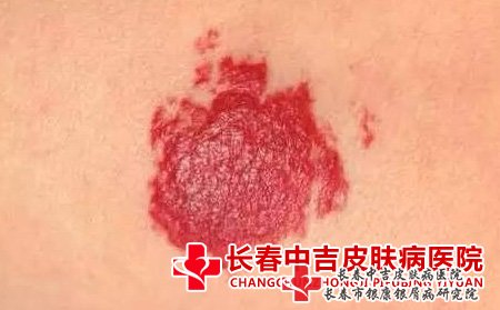 长春市去胎记医院:胎记治疗后会复发吗?