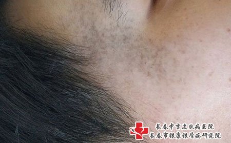 长春市去胎记研究所：太田痣的临床诊疗与研究