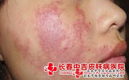 长春市去胎记的医院：红色胎记有治好的吗?