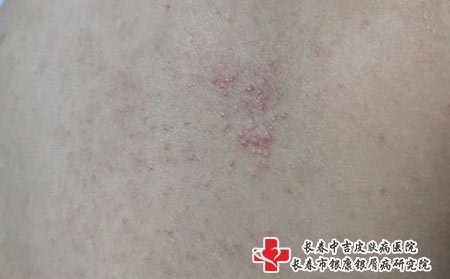 带状疱疹