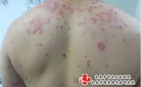 牛皮癣长在哪儿,牛皮癣发病部位
