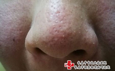 鼻子上长痤疮在饮食上要注意，保持皮肤清洁