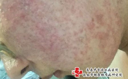长痤疮可以通过洗脸排毒和饮食排毒来治疗。