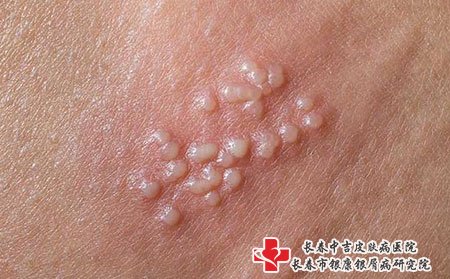 带状疱疹的水泡千万不要把用手挤破，容易造成感染