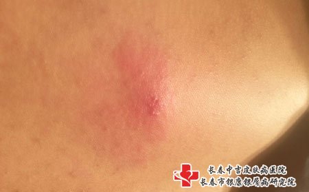 带状疱疹有四个治疗方式，一般治疗和药物治疗，中医治疗和局部治疗