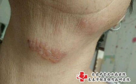 带状疱疹可以通过性传播，母婴传播，血液传播