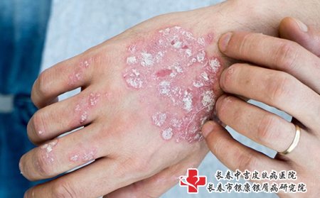 关节病型牛皮癣图片症状