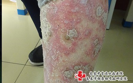 脓疱型牛皮癣图片症状