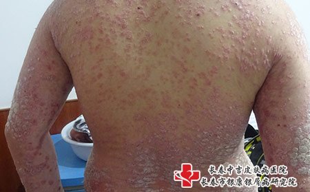 长春银屑病哪里好,长春治银屑病哪里好,长春银康银屑病哪里好,长春银康治银屑病哪里好,牛皮癣为什么难断根