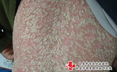 长春治银屑病,长春治银屑病哪里好,长春银康治银屑病,长春银康治银屑病哪里好,不同部位的牛皮癣