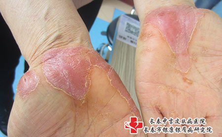 长春银屑病,长春治银屑病,长春银康治银屑病,牛皮癣的原因